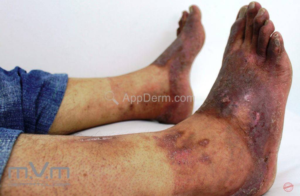 dermatite de contato