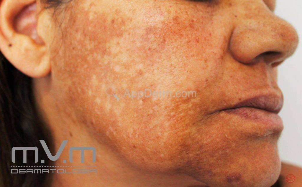 melasma