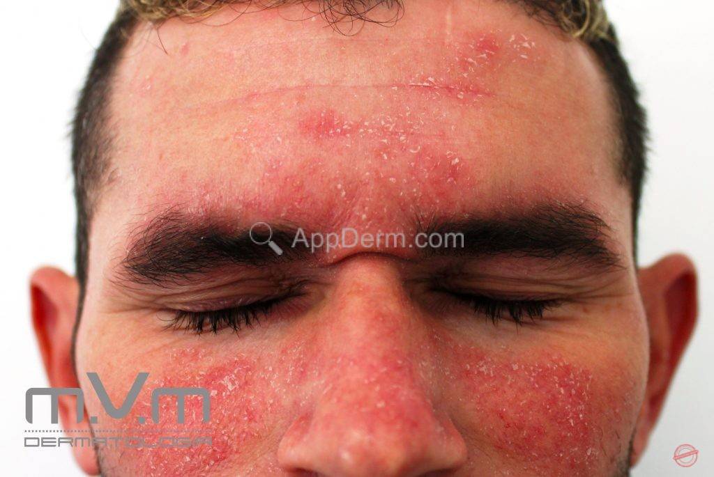 dermatite seborréica