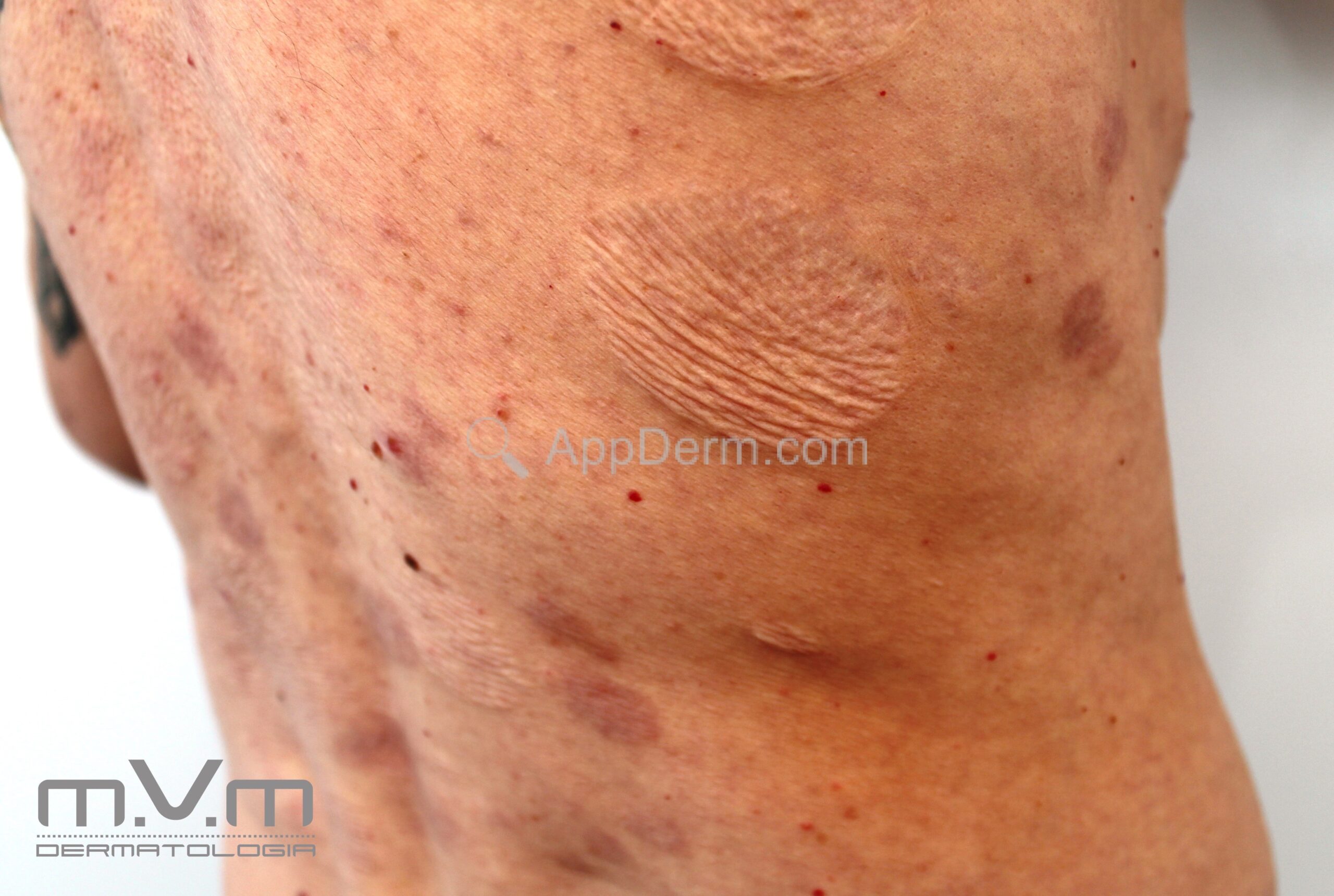 Anetoderma Face Anetodermias | Appderm