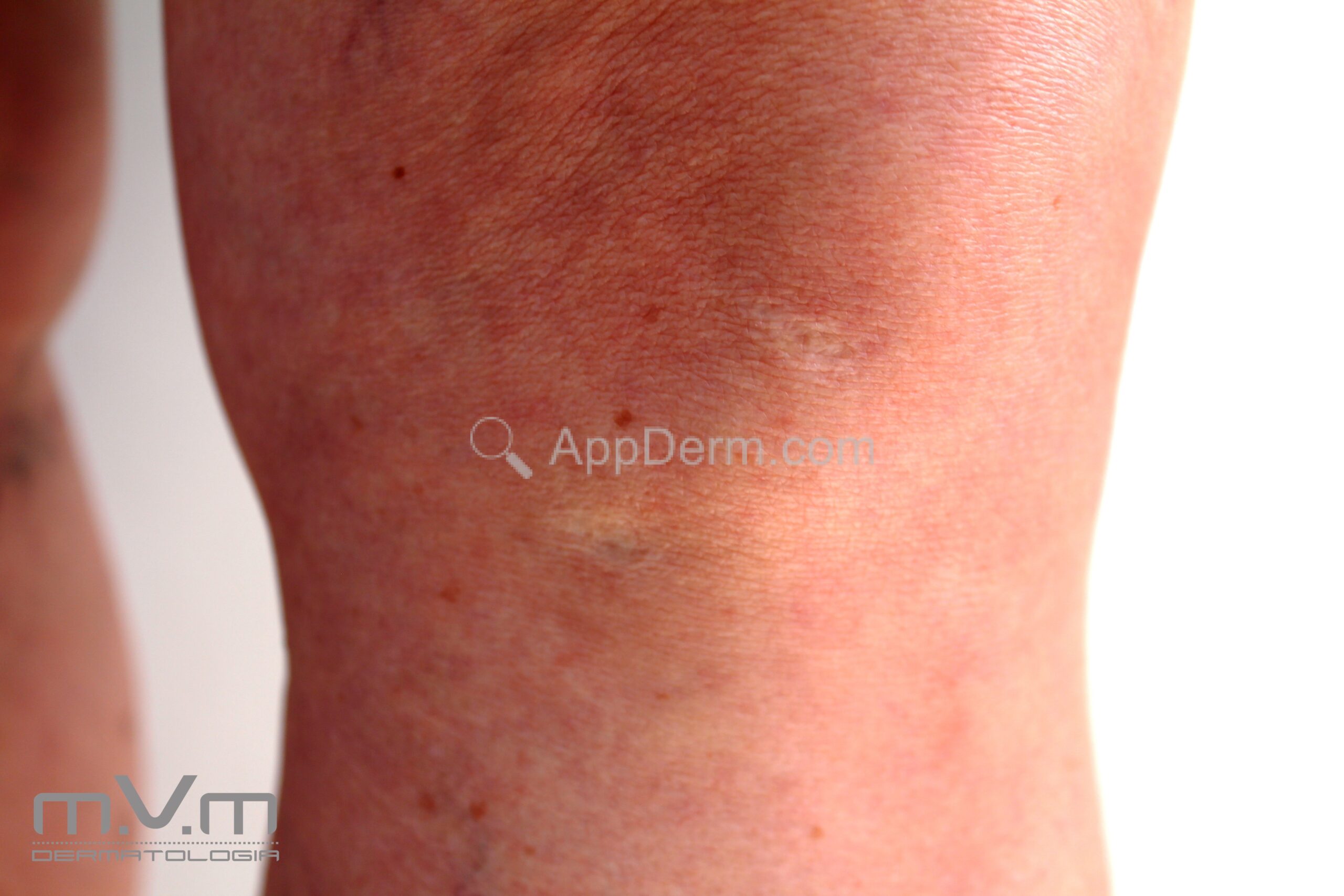 Anetoderma Face Anetodermias | Appderm