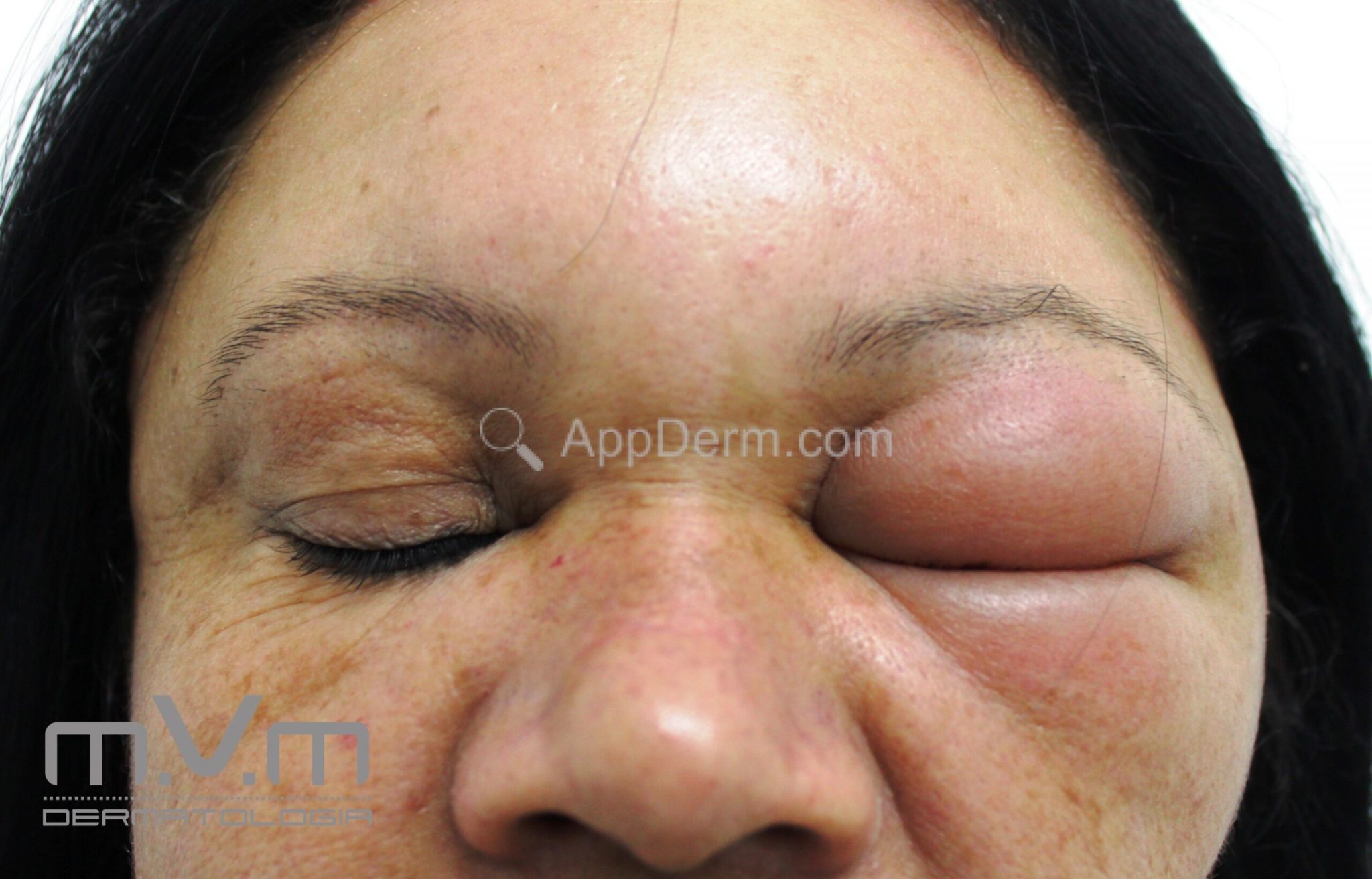Anetoderma Face Indice-doenças | Appderm