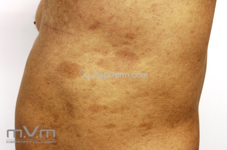 Atrofodermia de Pasini e Pierini (atrofodermia de Moulin) | Appderm