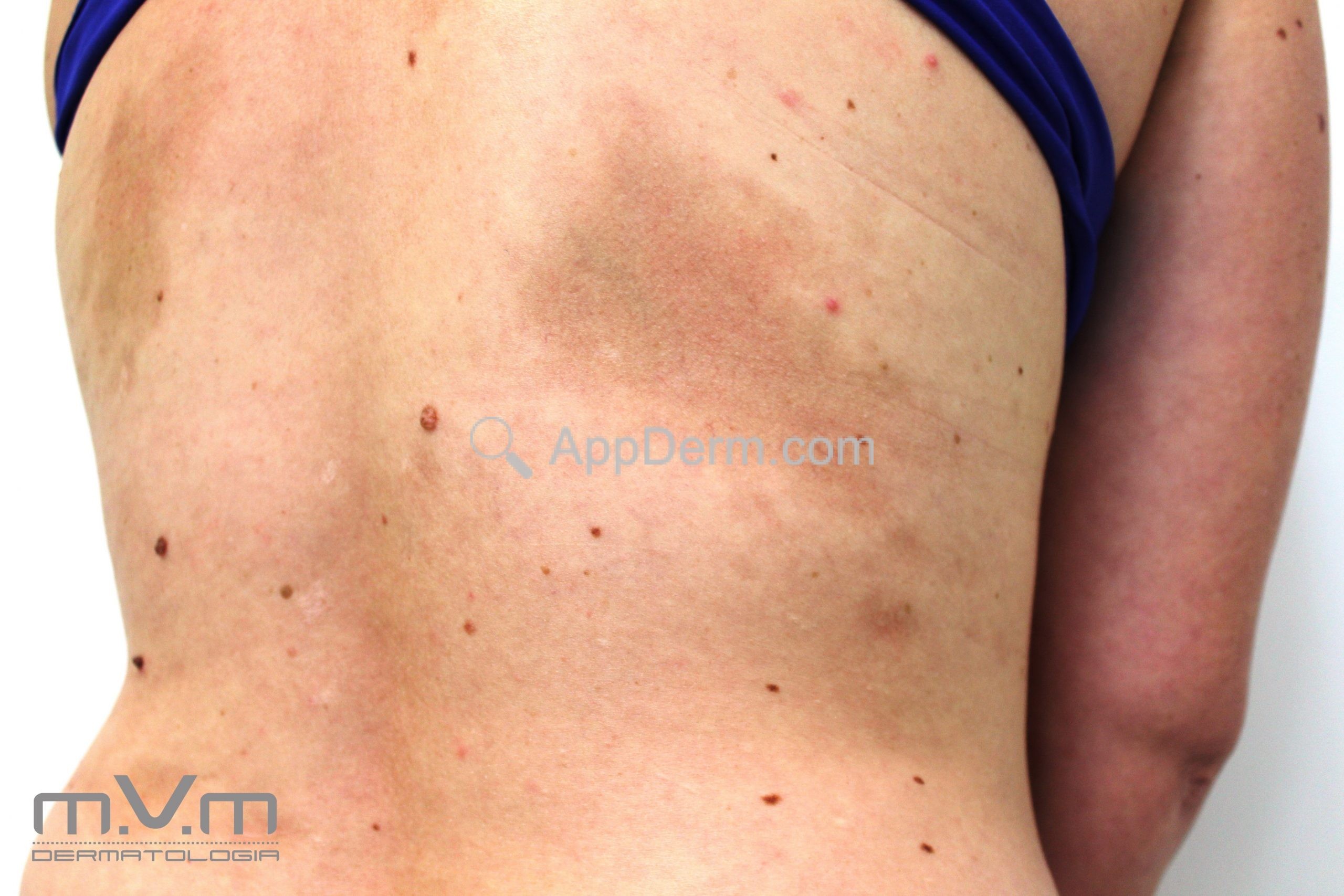 Atrofodermia de Pasini e Pierini (atrofodermia de Moulin) | Appderm