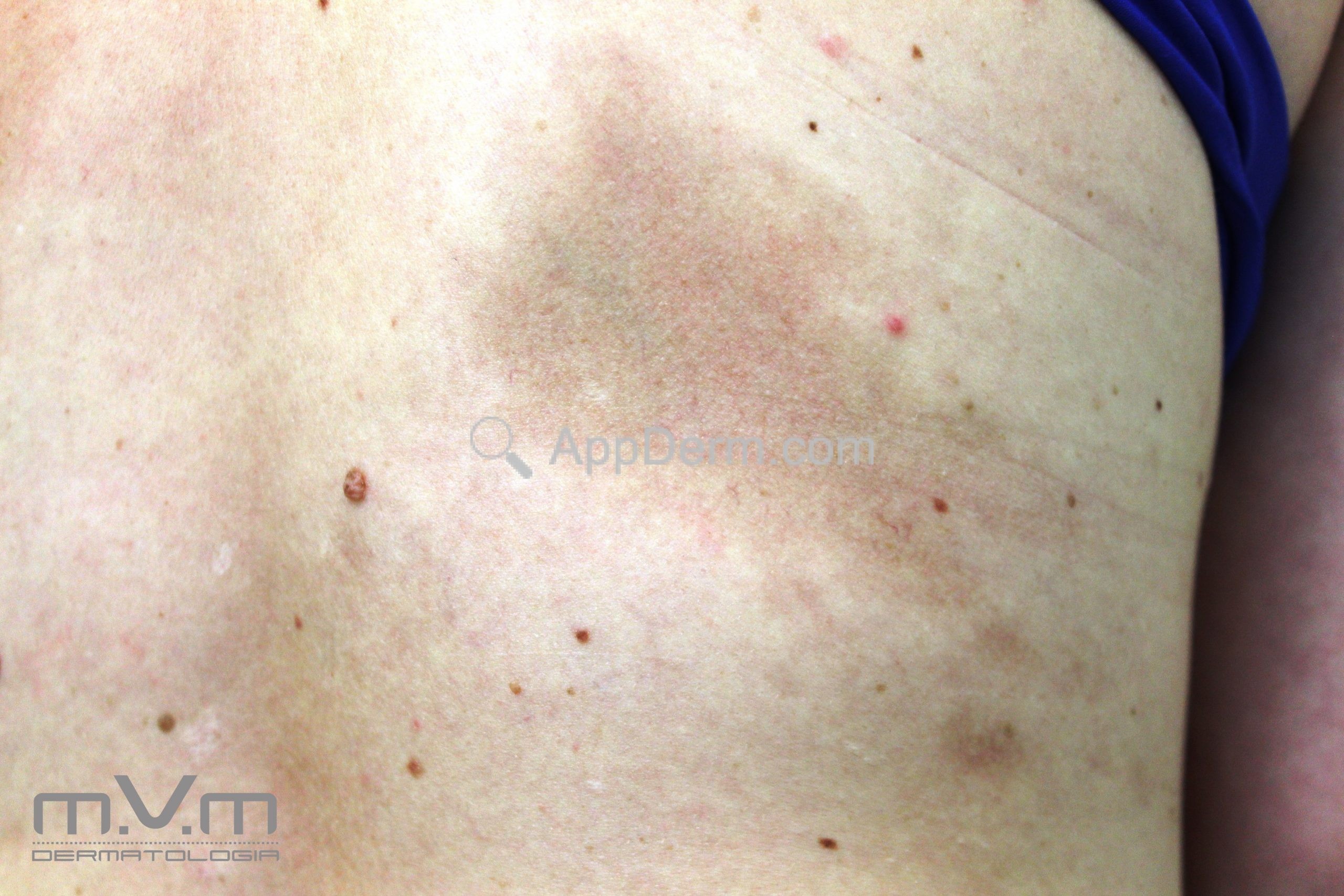 Atrofodermia de Pasini e Pierini (atrofodermia de Moulin) | Appderm