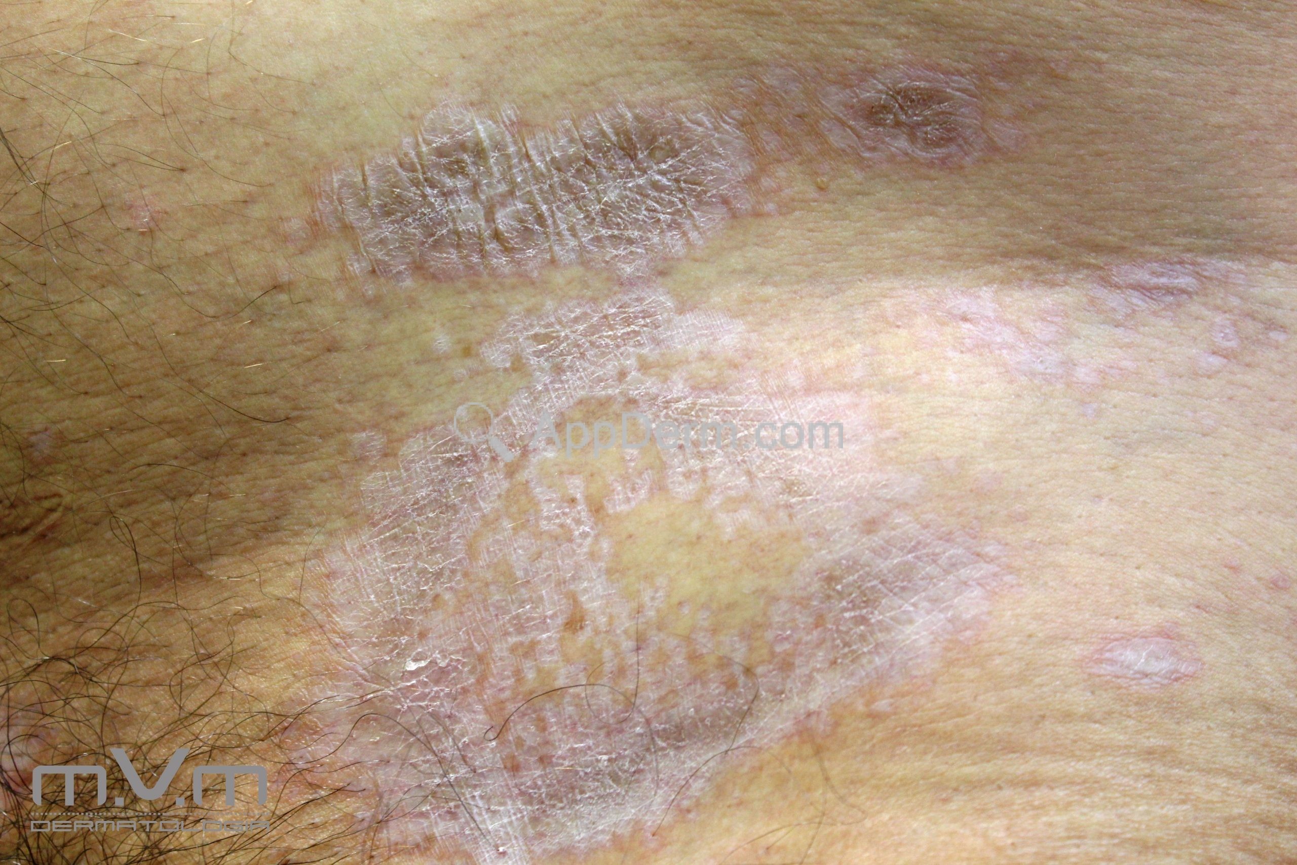 Líquen escleroso | Appderm