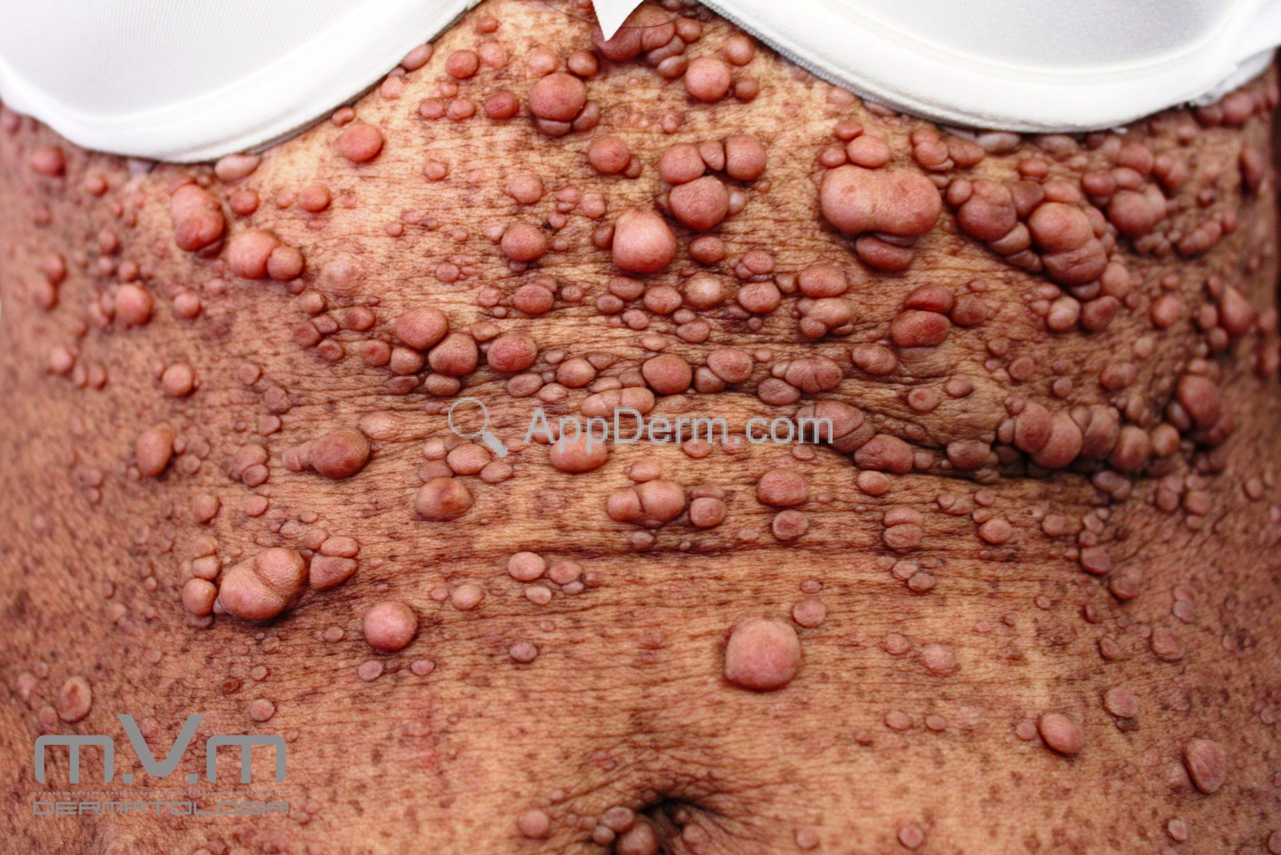 Neurofibromatose (doença de von Recklinghausen) | Appderm
