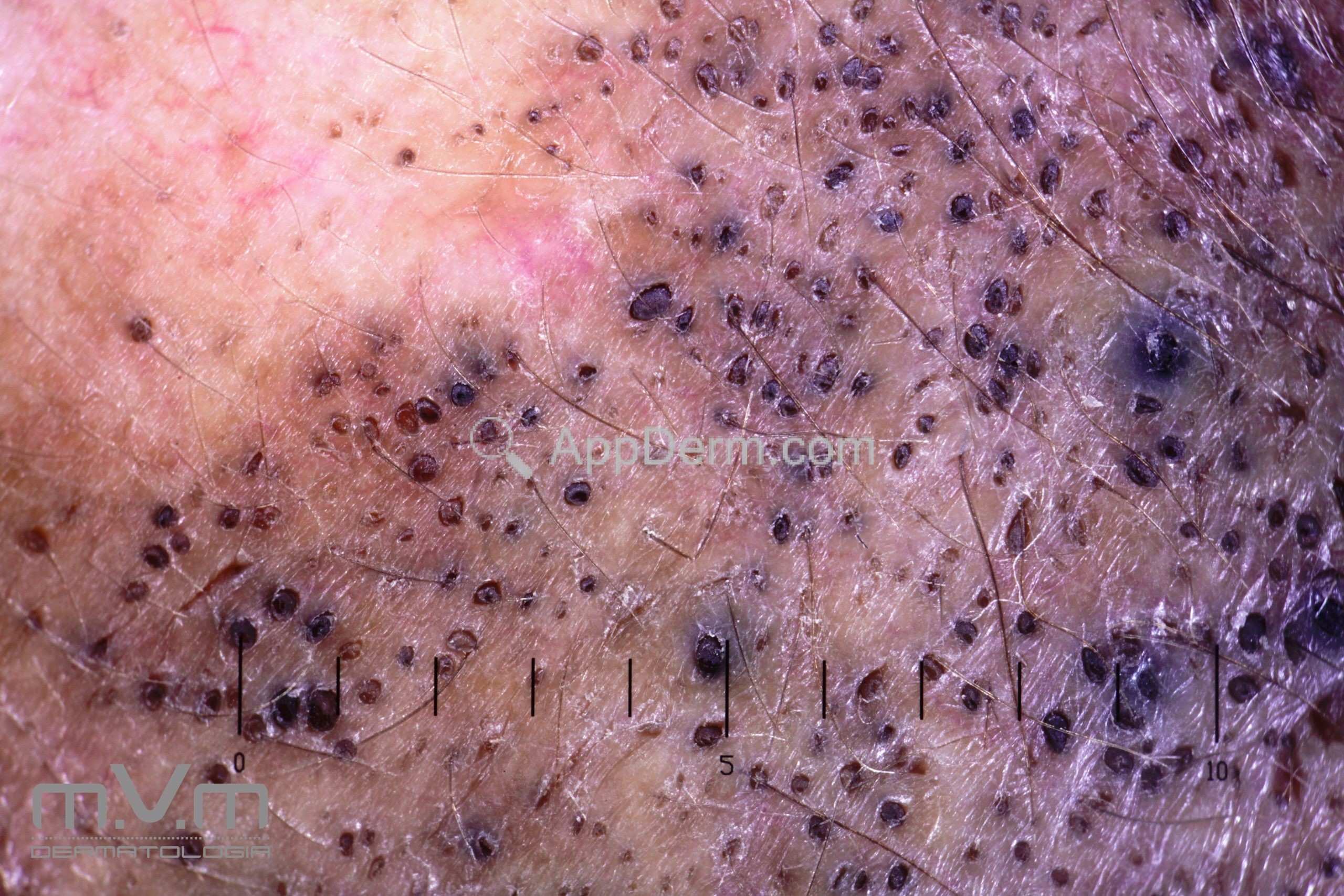 Síndrome de Favre-Racouchot | Appderm
