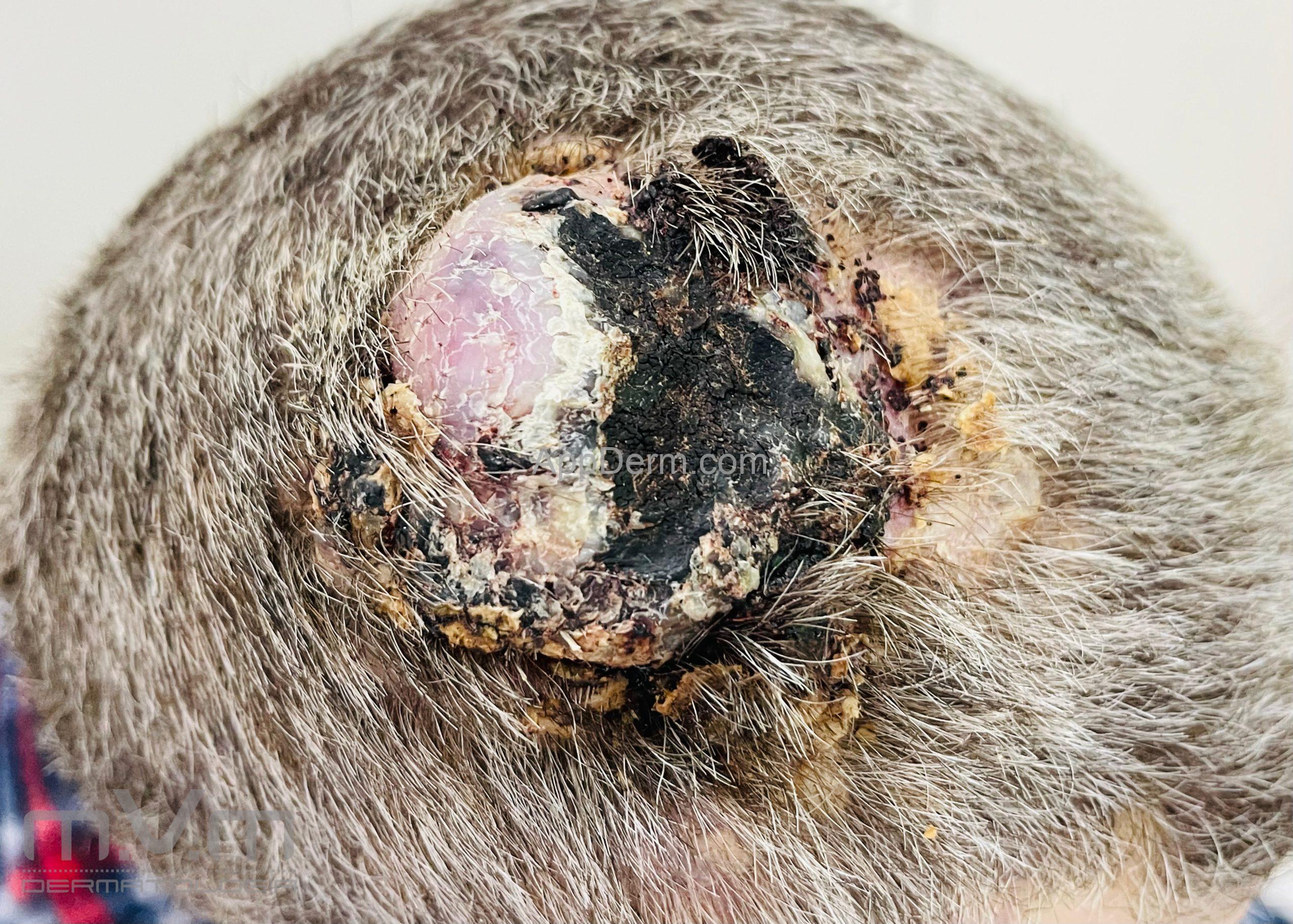 Angiossarcoma (hemangiossarcoma) | Appderm